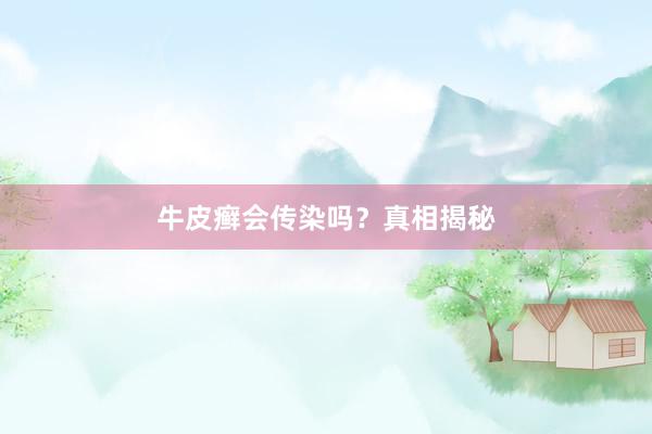 牛皮癣会传染吗？真相揭秘